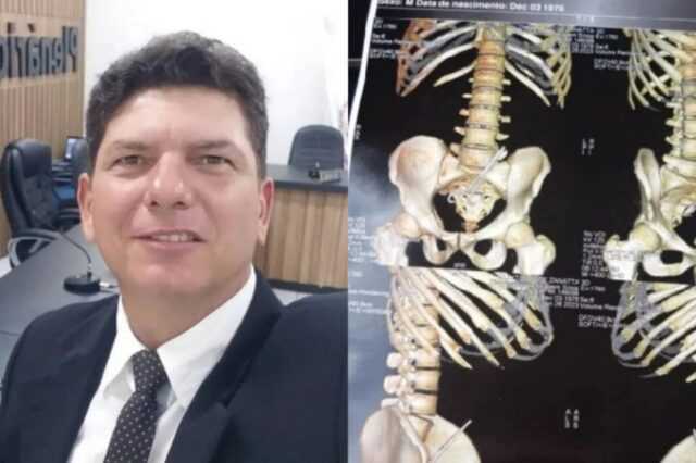 Tesoura é esquecida dentro do corpo de vereador após cirurgia