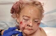 Menina de 5 anos leva 50 pontos no rosto após ataque de cachorro
