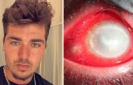 Saiba como jovem perdeu a visão após dormir usando lentes de contato: “Parasitas carnívoros comeram meu olho”