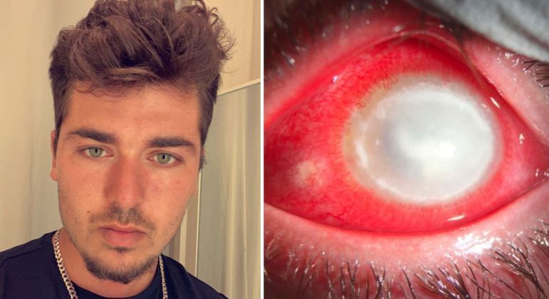 Saiba como jovem perdeu a visão após dormir usando lentes de contato: “Parasitas carnívoros comeram meu olho”