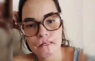 Mulher que perdeu lábios após preenchimento desabafa: “Fui enganada”