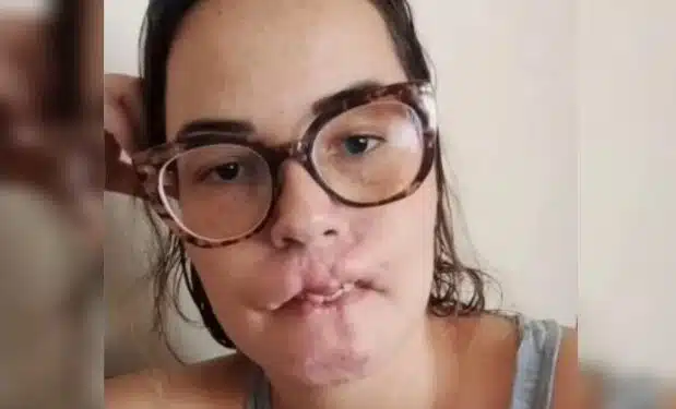 Mulher que perdeu lábios após preenchimento desabafa: “Fui enganada”