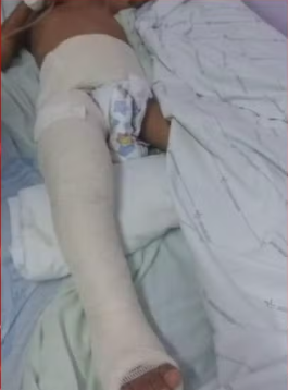 MP-AL denuncia mãe e padrasto de criança espancada que teve fêmur quebrado e pede perda da guarda