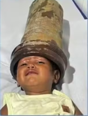 'Nasceu novamente', diz mãe de menino de 2 anos que ficou com cabeça presa em tubo de aço em AL