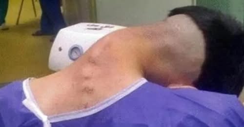 Irã registra caso raro de síndrome da cabeça caída por uso de drogas