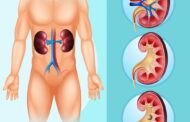 Dor nas costas? Urina escura? 8 primeiros sinais de pedras nos rins que você não deve ignorar